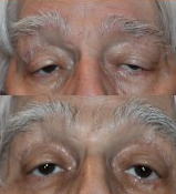Before and After Ptosis Surgery