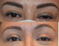 Before and After Ptosis Surgery