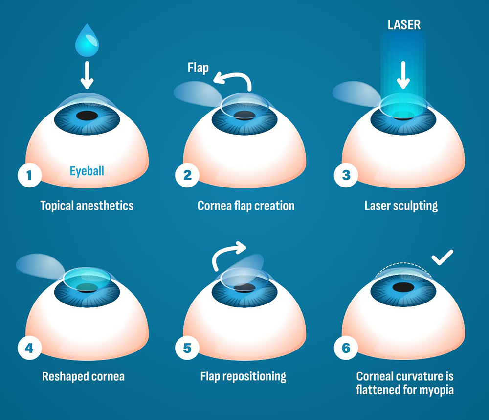 LASIK Steps